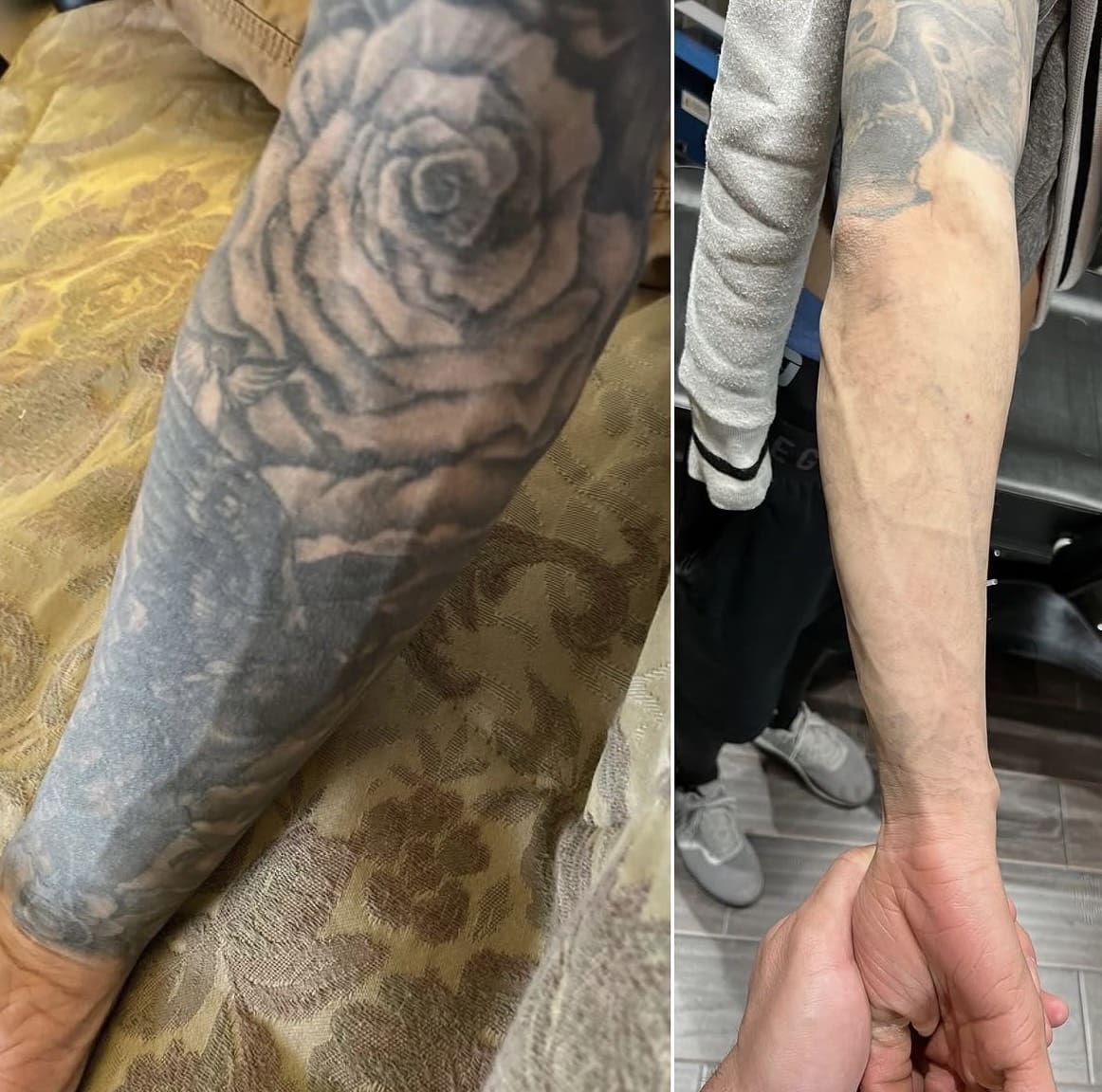 Tattoo removal before and after - sleeve tattoo clearance